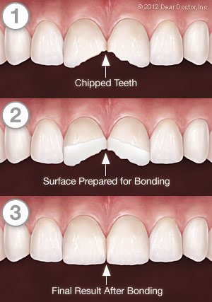 Cosmetic Tooth Bonding in Jacksonville Tx