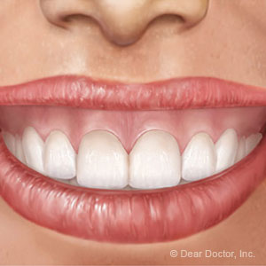 gum recession