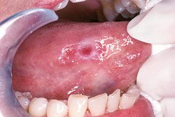 Detecting Oral Cancer By Oral Cancer Screening In Jacksonville, Tx