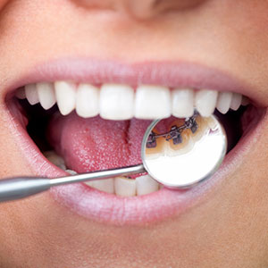 Lingual Braces Offer A Less Visible Alternative To Traditional Braces