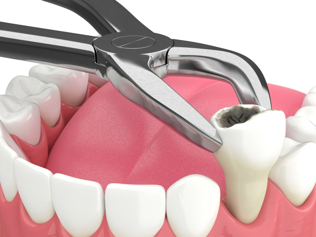 Do’s And Dont’s Post Tooth Extraction