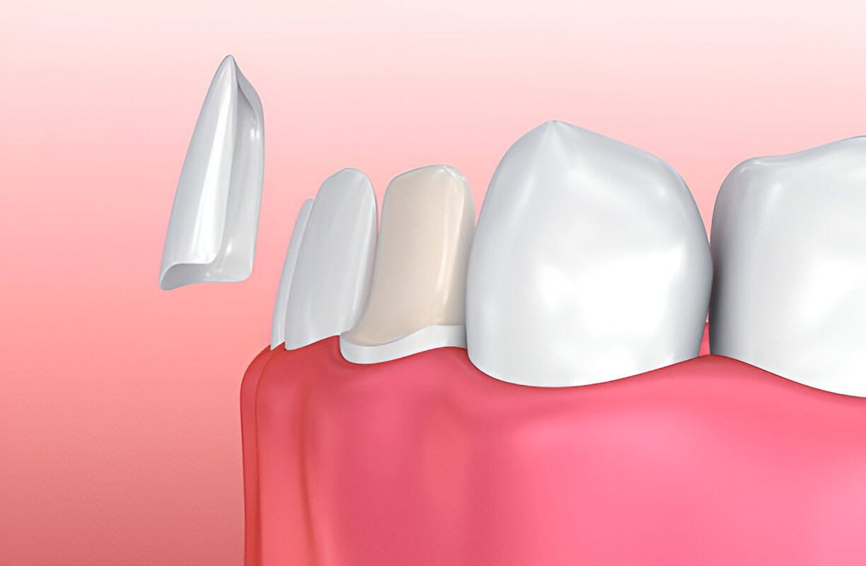 Cherokee Family Dental: Transform Your Smile with Porcelain Veneers in Jacksonville, TX_FI