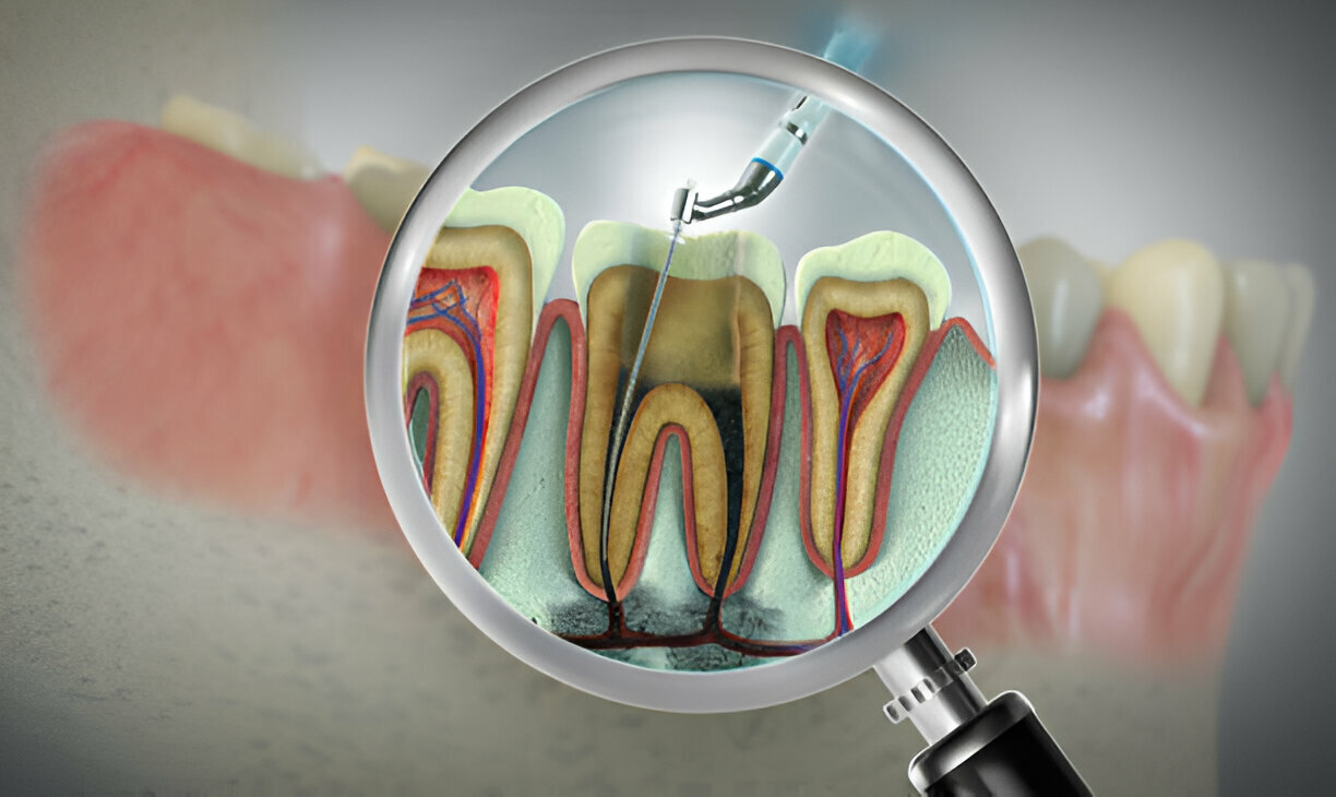 Root Canal Treatment: Expert Care at Cherokee Dental Professionals in Jacksonville_FI