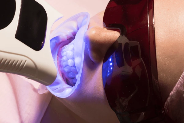 Professional teeth whitening treatment at dental clinic compared to hydrogen peroxide home remedy